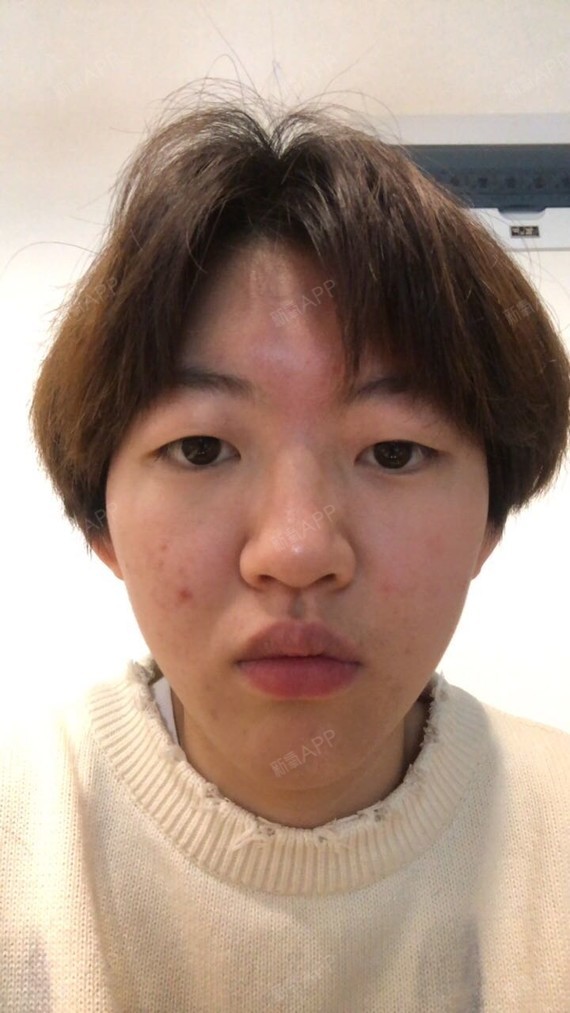 【真人案例】做完眼睛后再也没人说她是小男生了!