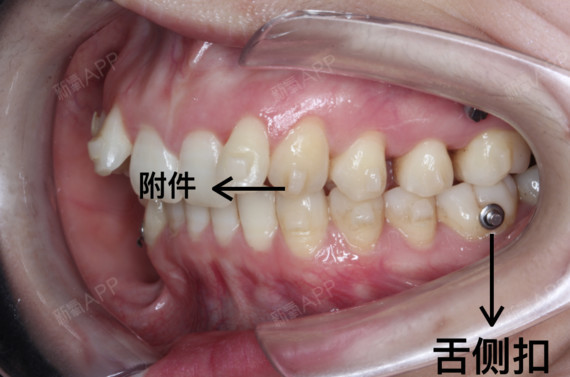 粘舌侧扣步骤图片