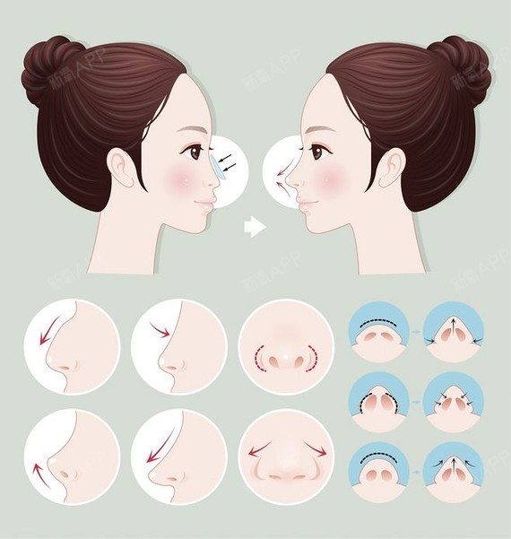 鼻背中轴线上有两处凹陷,使鼻中轴线不完整流畅; 鼻孔横卧鼻 由于鼻端