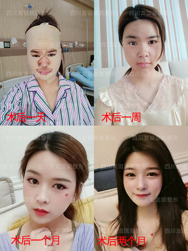 轮廓整形 张立天博士案例库 76 术前沟 圈子 新氧美容整形