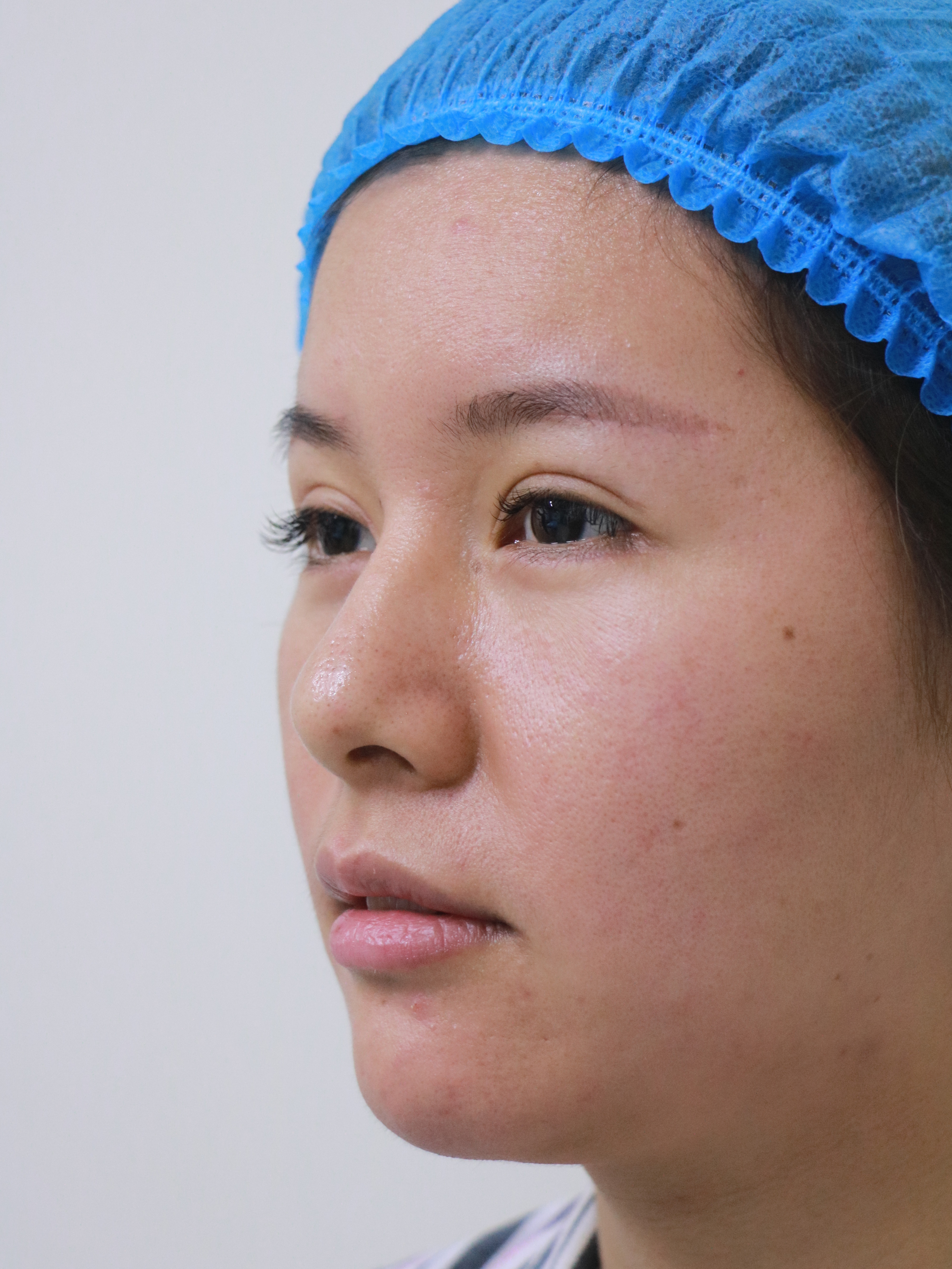 第3天做完眉弓和眼部多项已经第三天了,前几天太肿_圈子-新氧美容整形