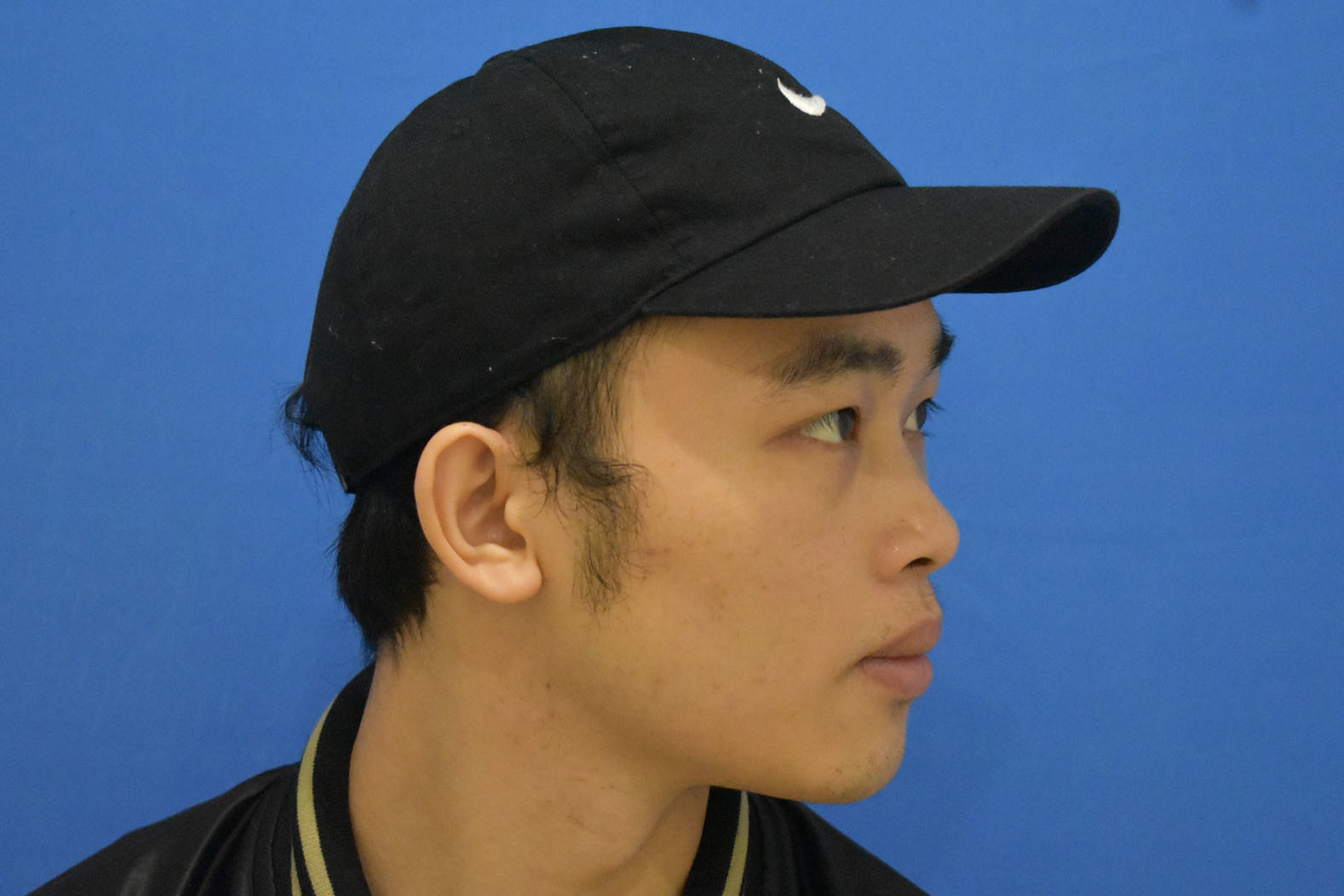 下巴后缩不够男人味,我这次是过来补打的,以前也打过_圈子-新氧美容