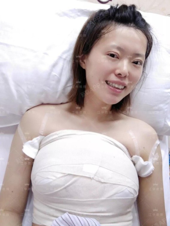 隆胸纪实活了24岁最大的一个决定