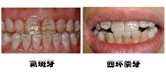内源性黄牙主要有两种 氟斑牙和四环素牙