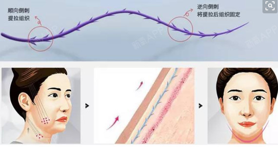 大v线提升为什么凹陷?