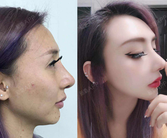 假体眉弓科普 :术后会影响皱眉等表情吗?