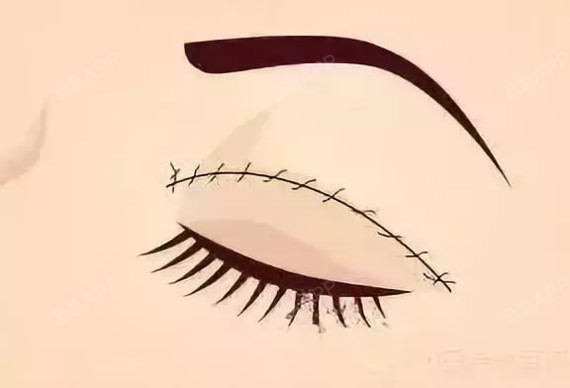 全切双眼皮,居然是这样割出来的!