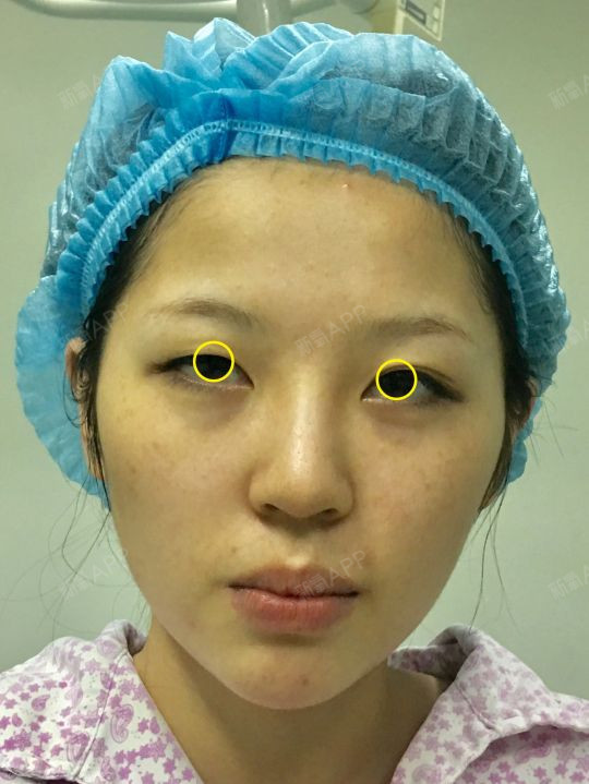 豆豆眼,眼角包,还睁不开眼,这样的宝宝,做了最挑人_圈子-新氧美容整形