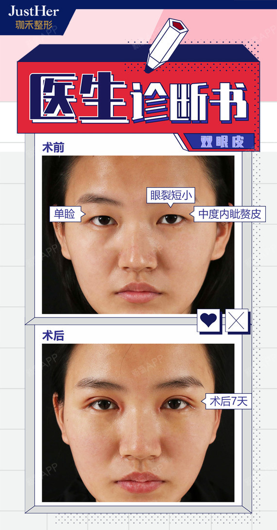 姑娘天生单眼皮,有中度内眦赘皮,眼裂比较小,不接受