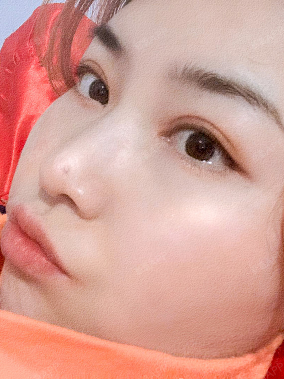 98为什么做双眼皮少不了上睑提_圈子-新氧美容整形