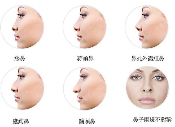 1,低鼻:从鼻根到鼻尖,整个鼻子都比较低; 2,鞍鼻:鼻梁高度低,鼻梁和