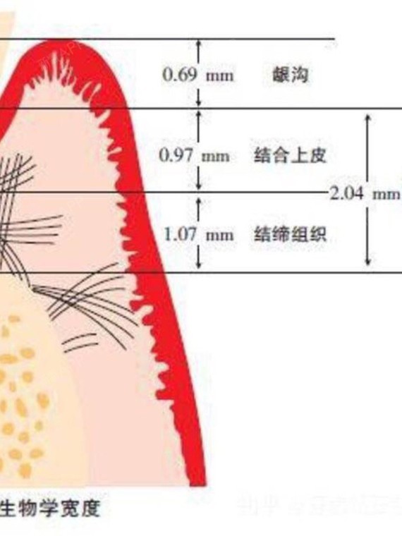 牙齿矫正真的会引起牙龈萎缩吗?牙龈萎缩是怎样形成的?