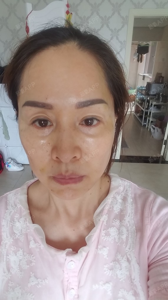 我做的中下面部线雕,现在已经第三天了,感觉脸部还是_圈子-新氧美容