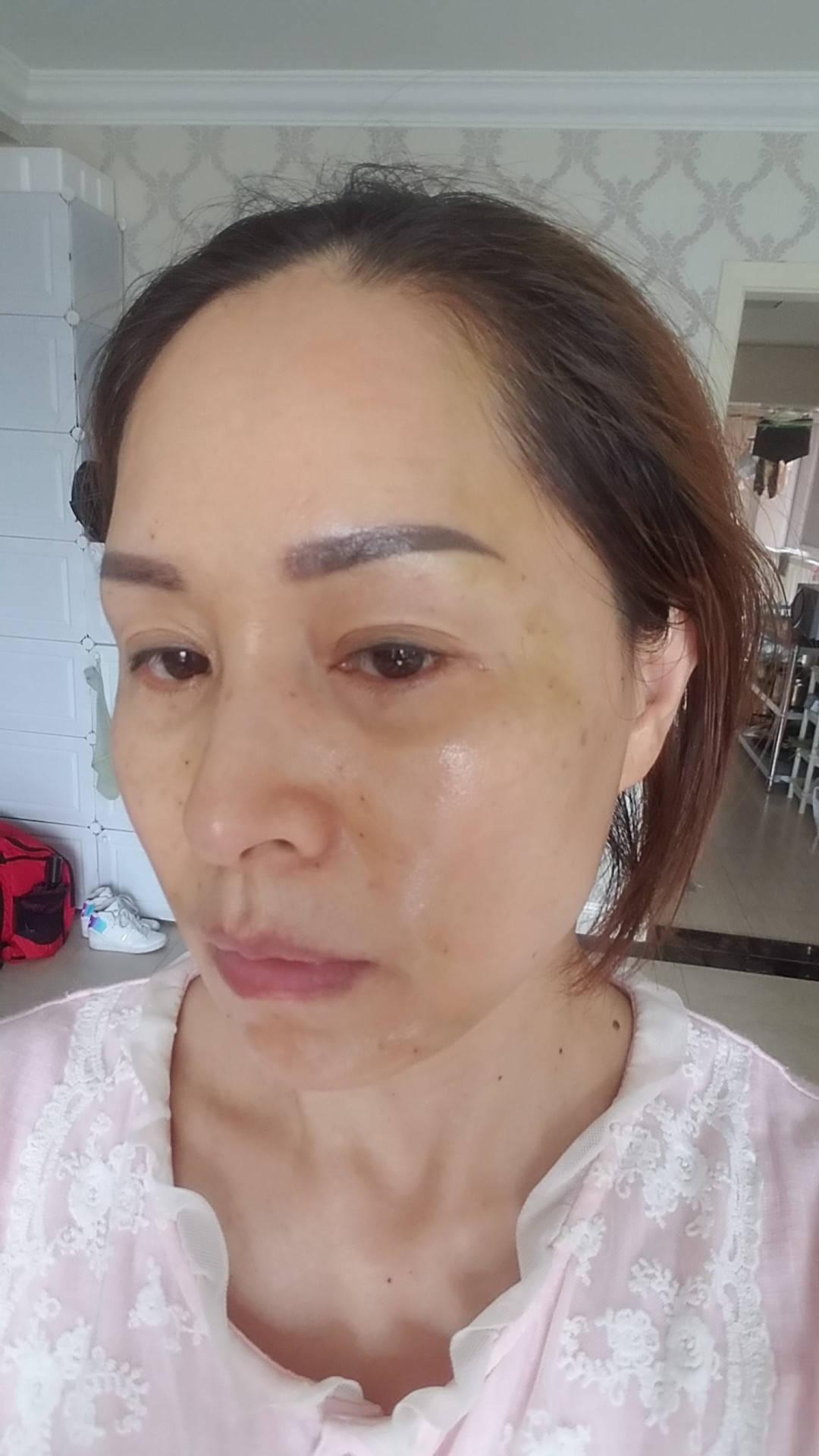 我做的中下面部线雕,现在已经第三天了,感觉脸部还是_圈子-新氧美容