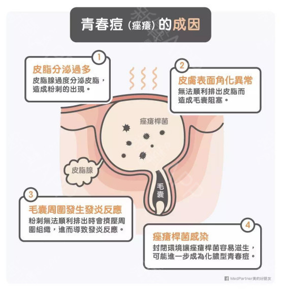 而导致皮脂腺分泌旺盛的主要因素有以下几种