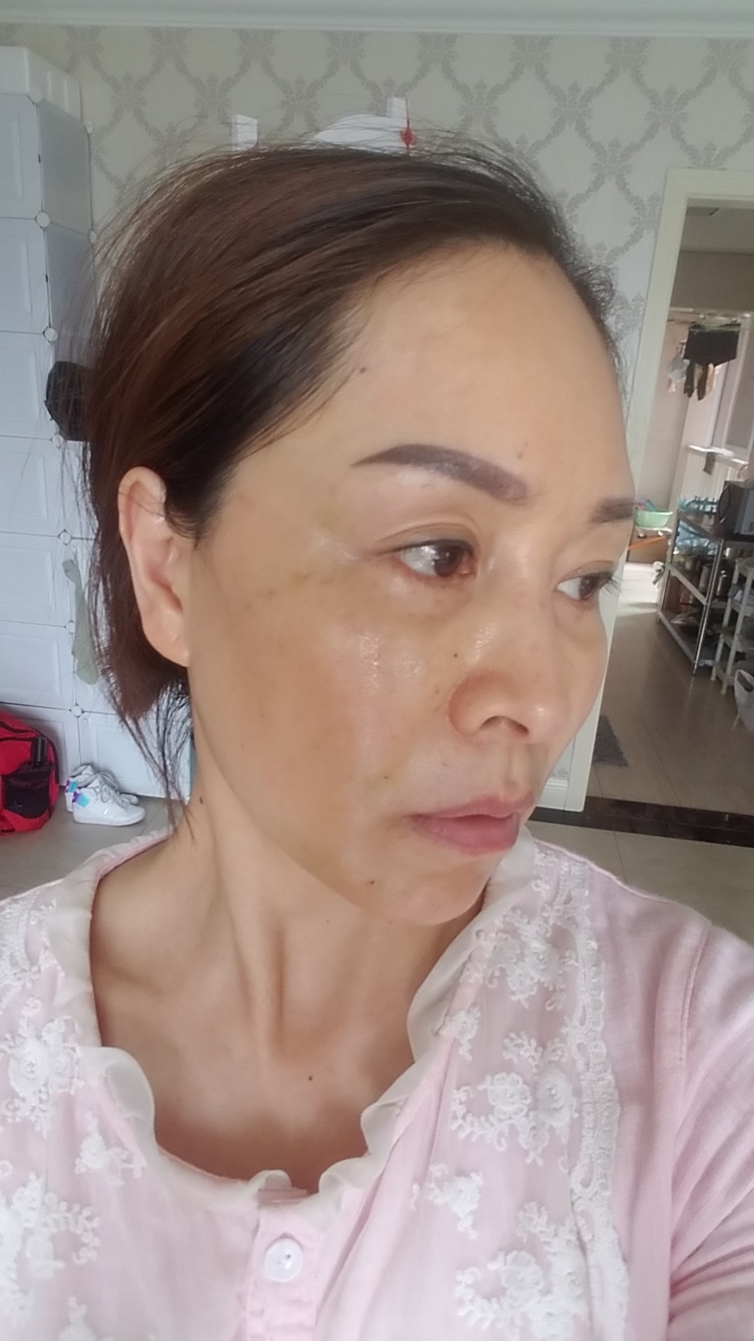 我做的中下面部线雕,现在已经第三天了,感觉脸部还是_圈子-新氧美容