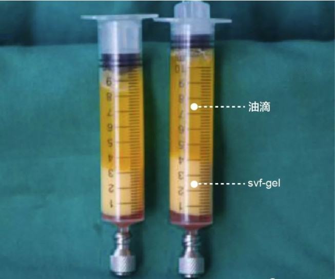 Svf Gel脂肪胶是什么 真的比普通脂肪填 新氧美容整形
