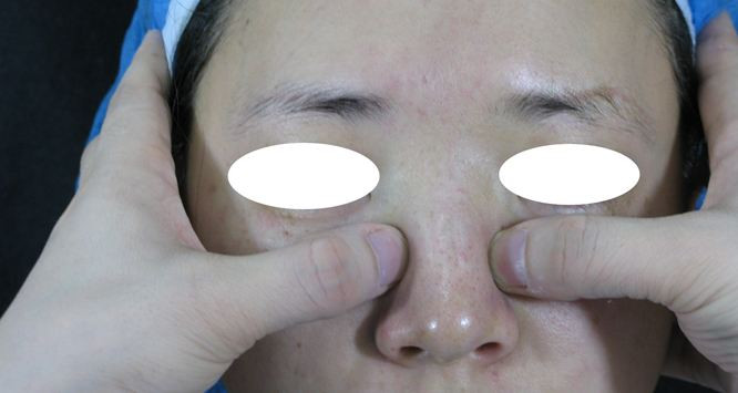 鼻骨内推是什么会影响呼吸吗