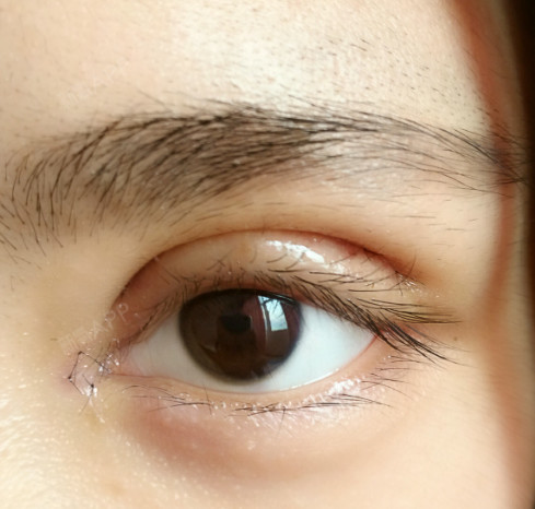 开眼角前后对比照片图分享 放大效果满分,成功蜕变大眼萌妹!