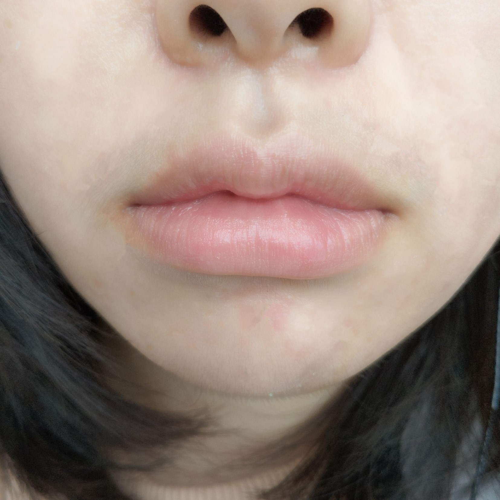 今天是做完m唇手术的第七天了,发几张照片来跟大家分_圈子-新氧美容