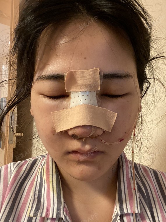取的肋软骨隆鼻,医生说可能会留下2厘米左右的疤痕,_圈子-新氧美容
