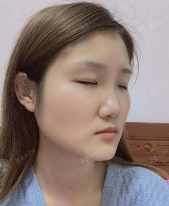 耳软骨隆鼻手术记录膨体双侧耳软骨