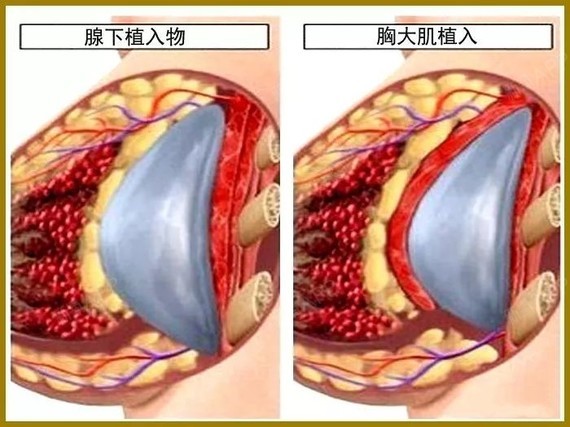 扁平胸ct测量标准图片