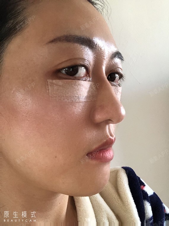 美容整形眶隔脂肪释放术后第0天_新氧美容整形
