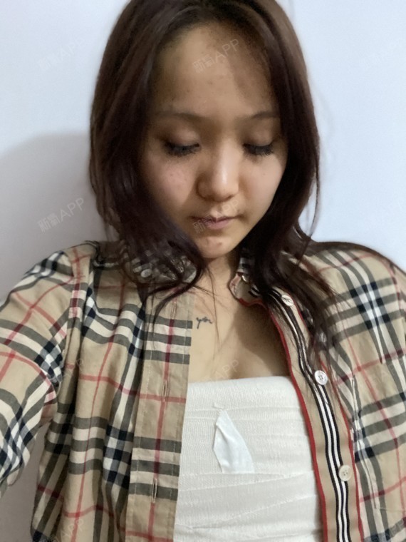 【假体隆胸项目术后第7天】