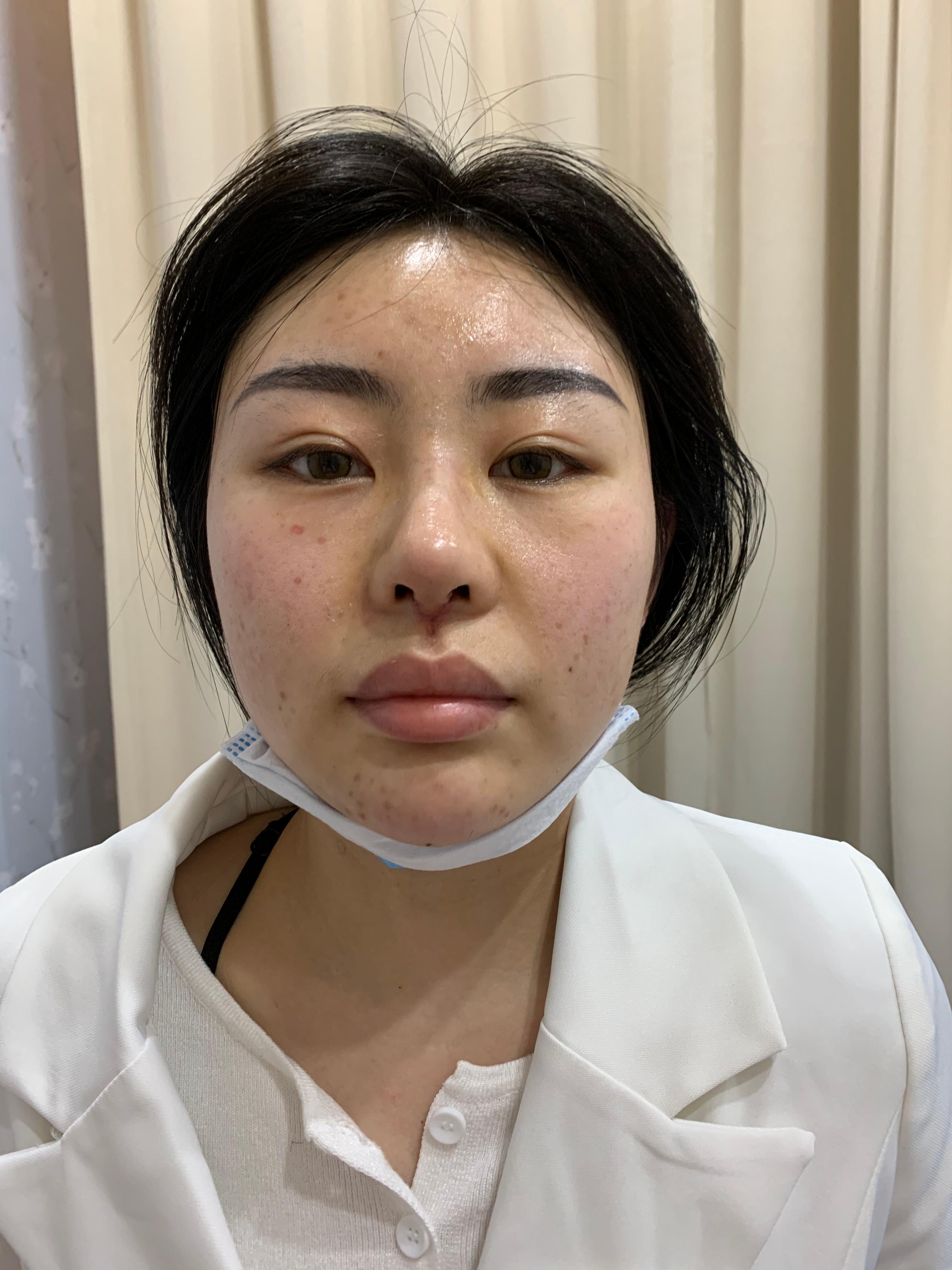 术后7天今天到院拆线了,之前伤口可能碰到水了,有一_圈子-新氧美容
