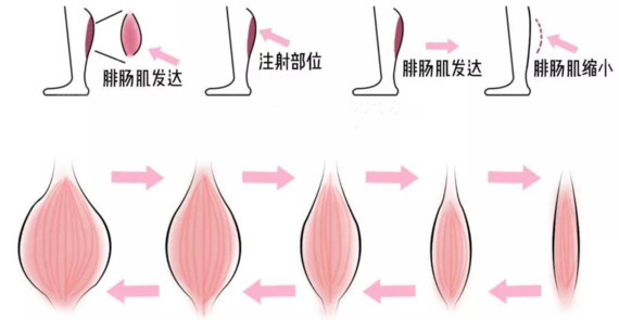 【注射瘦小腿】打了瘦腿针有什么注意事项?