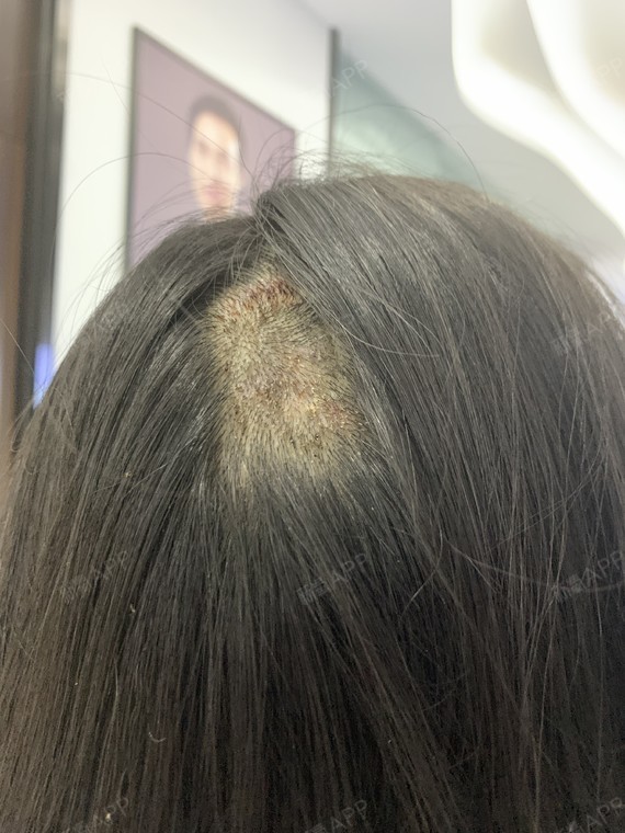 我是因为小时候一场小手术在头上留下了疤痕,_圈子-新氧美容整形