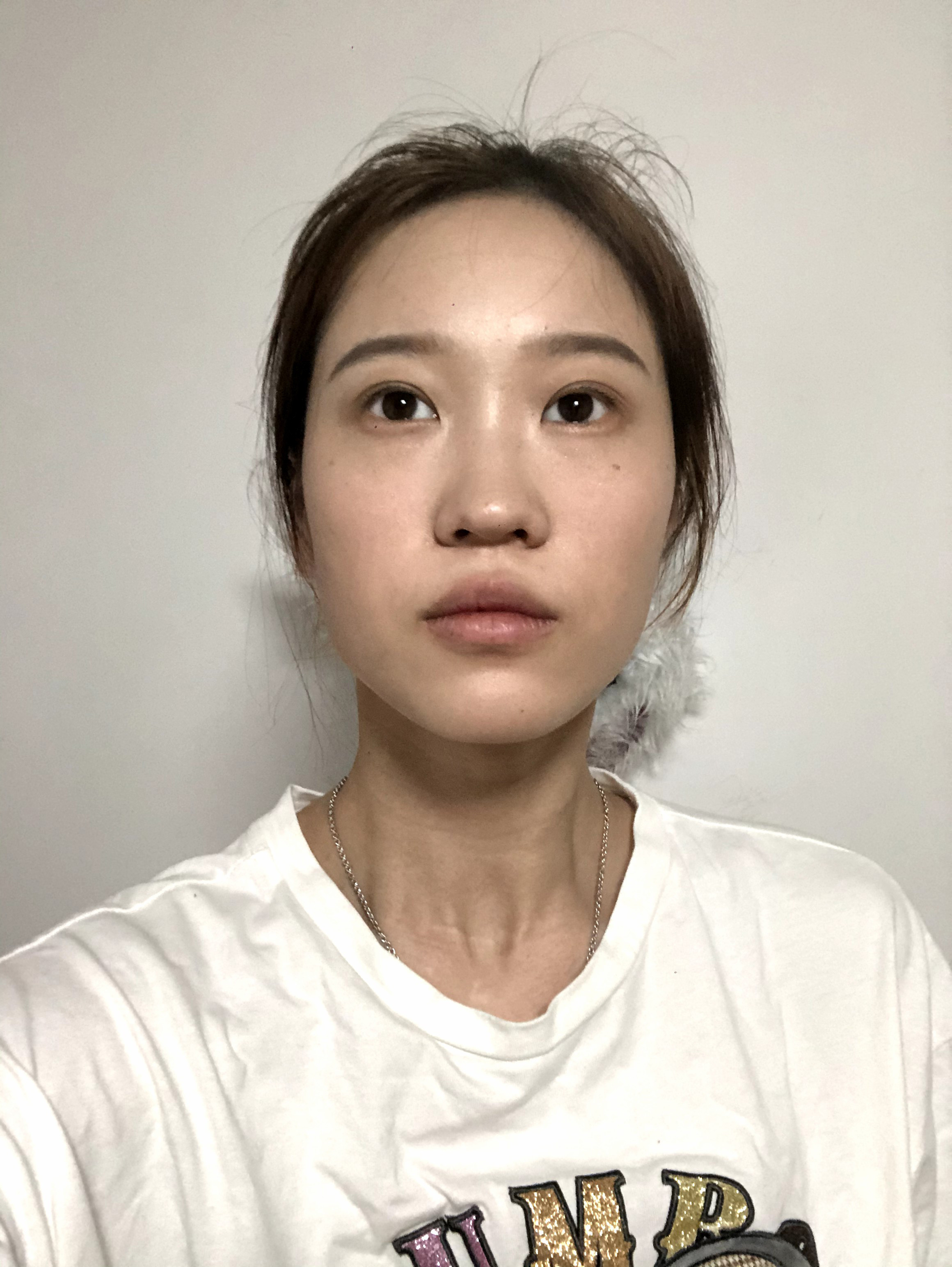 我是那种山根低鼻梁短鼻翼宽,一张毫无新意平平无奇的_圈子-新氧美容