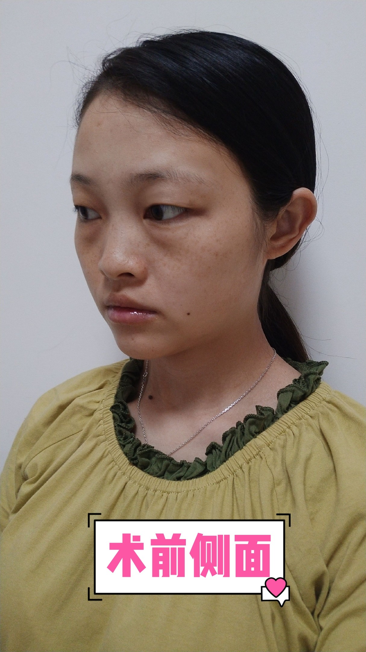 眼球突出者如何选择双眼皮方案?