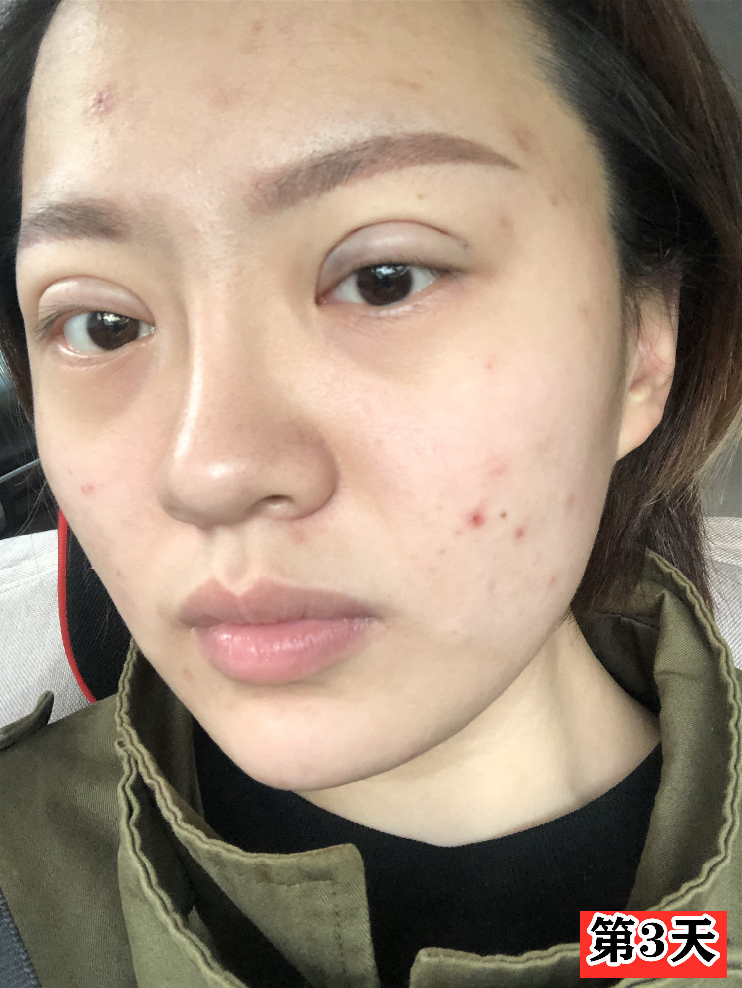 做的双眼皮能自然到什么程度肿眼泡的你打算怎么办?