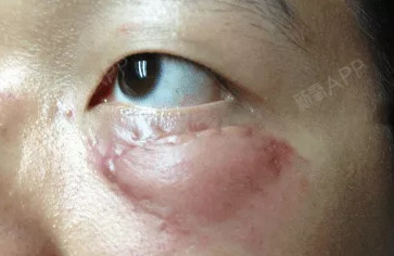脑壳疼做完内切眼袋多久恢复内切眼袋硬块多久消失