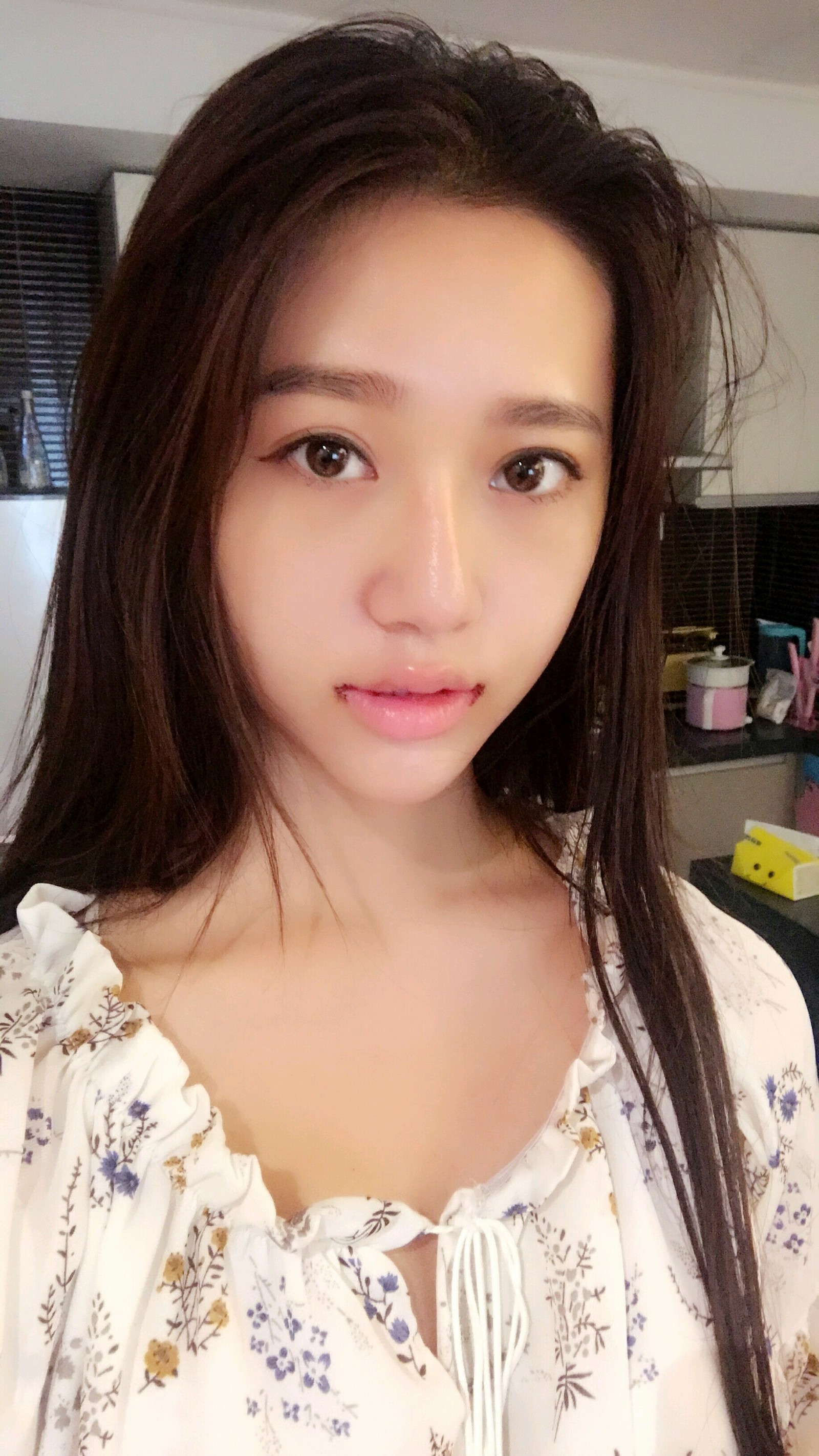 厚唇改薄手术做完的第七天了,去医院把嘴角线拆了,医生护士都说恢复得