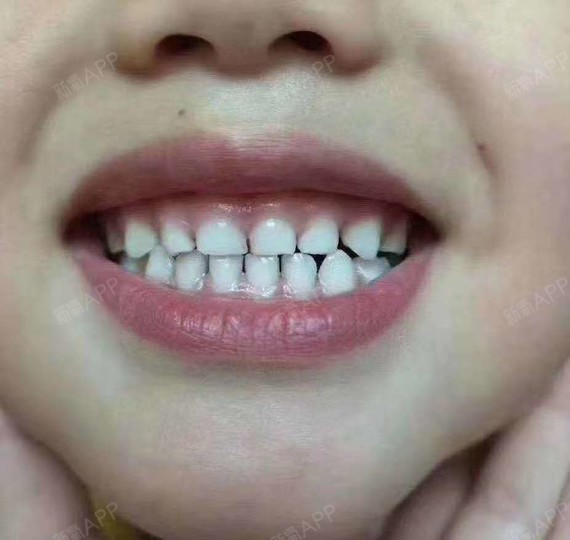 1,对比恒牙来讲,乳牙的钙化程度低,耐酸性差,所以更加容易受酸性物质