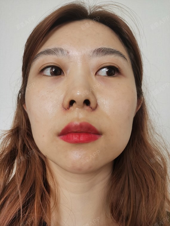 鼻翼缩小北京宫国华手术缩鼻翼术后1天