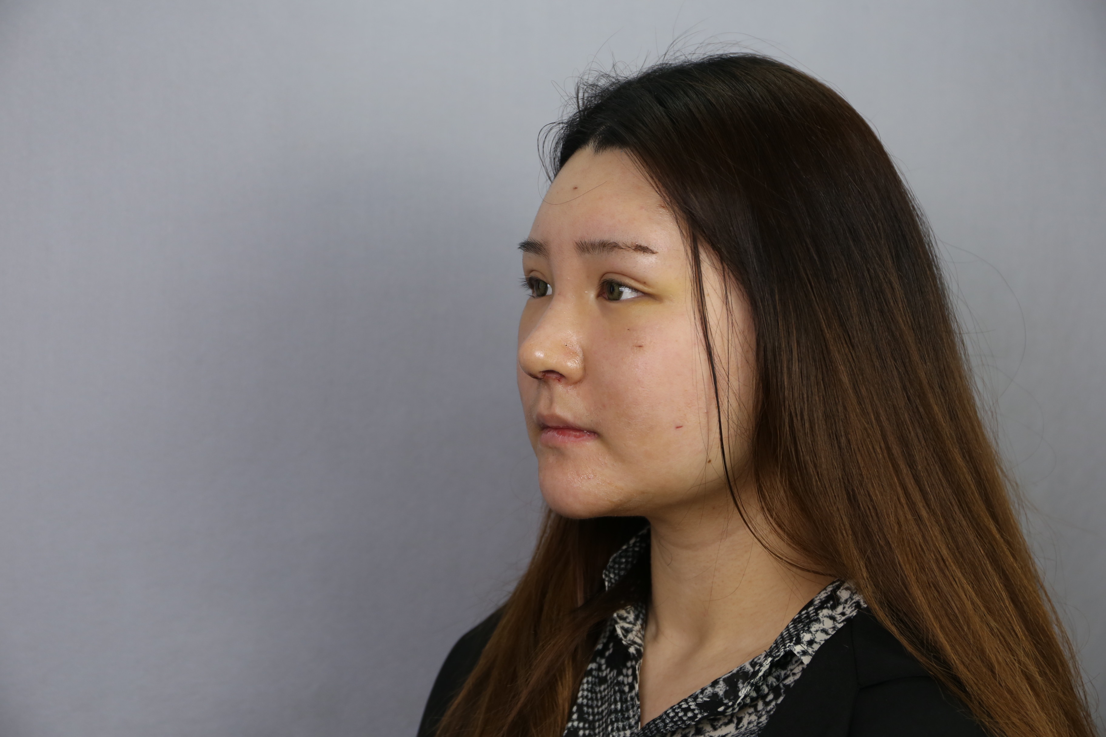 大连科美杨明洁鼻翼缩小术后第7天