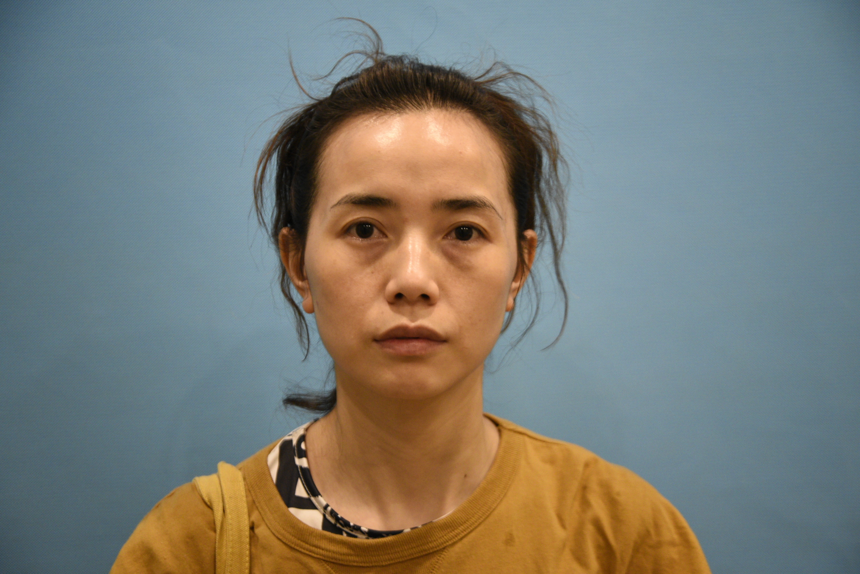 眼袋和脸凹是我现在最想要解决的面部问题,眼袋这个东_圈子-新氧美容