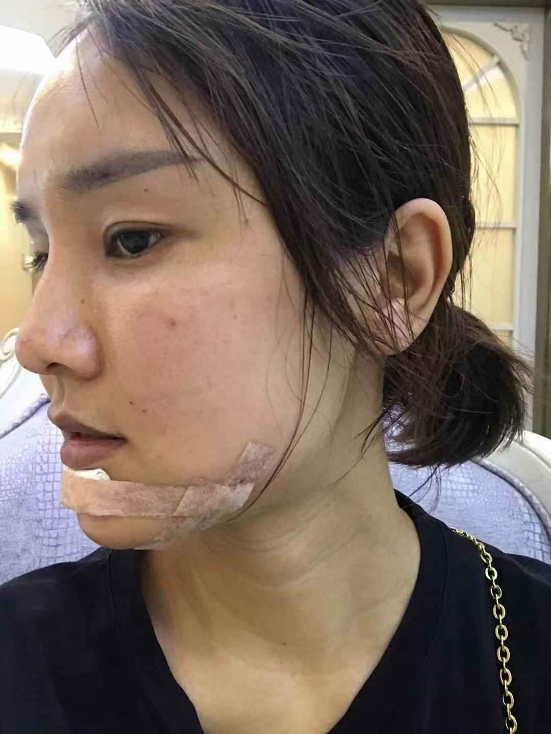 做手术前,我的脸属于那种非常凹的状态,都说太阳穴太_圈子-新氧美容