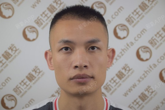 托尼植发术(托尼剪发见真容)