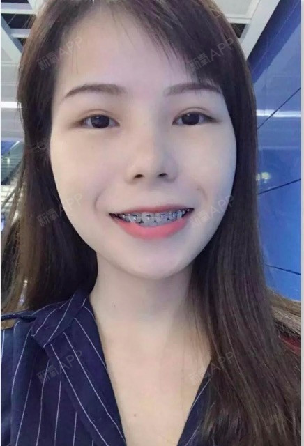 矫正对我脸型改变很大!但是同时因为带牙套我也瘦了近20斤!