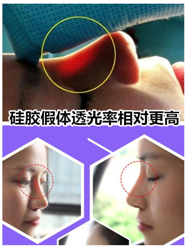 硅胶取出鼻子变化图片图片