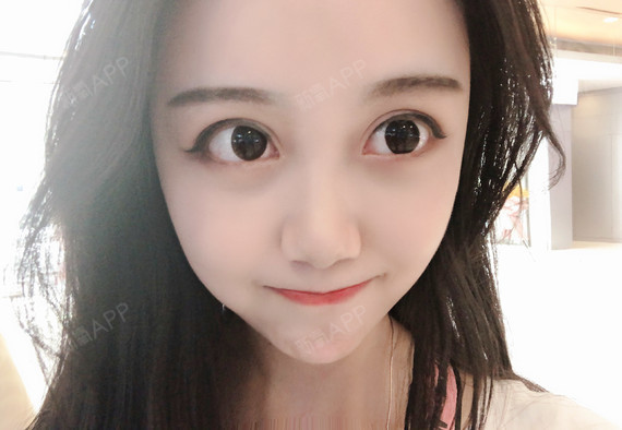 【沈阳童颜】【双眼皮】【第一百三十六天】