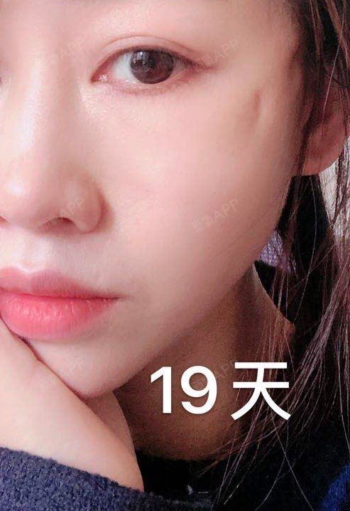 线雕线断了怎么处理?