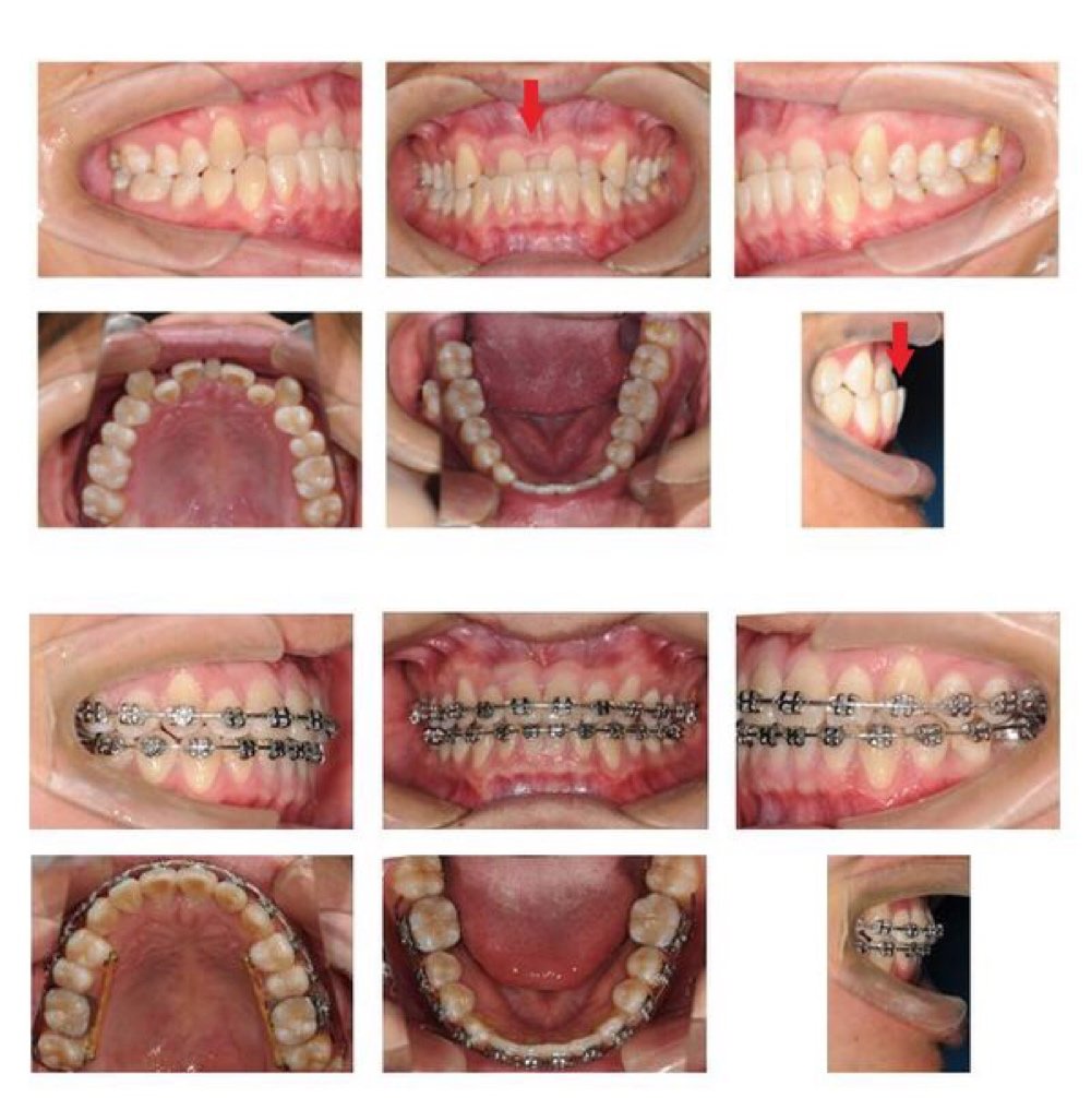 上圖箭頭所指為上門牙中間多長出的小牙(多生牙)及側面前牙咬合