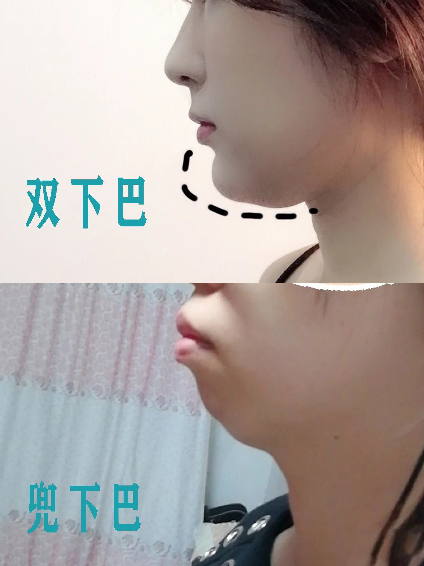 要不要丰下巴看完这5点再决定也不迟