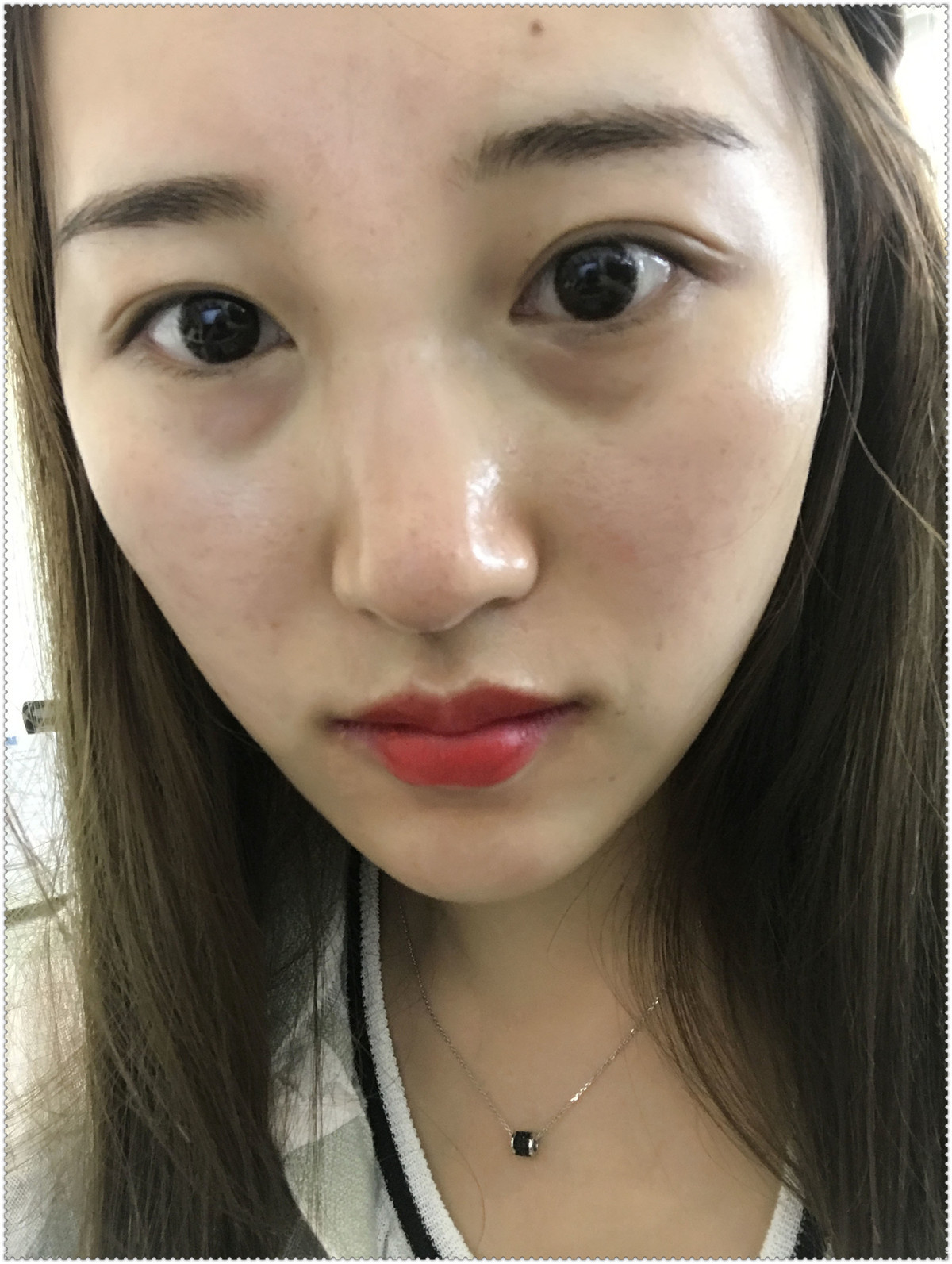 面部提升做线雕能维持多久_面部提升线雕视频_线雕面部提升